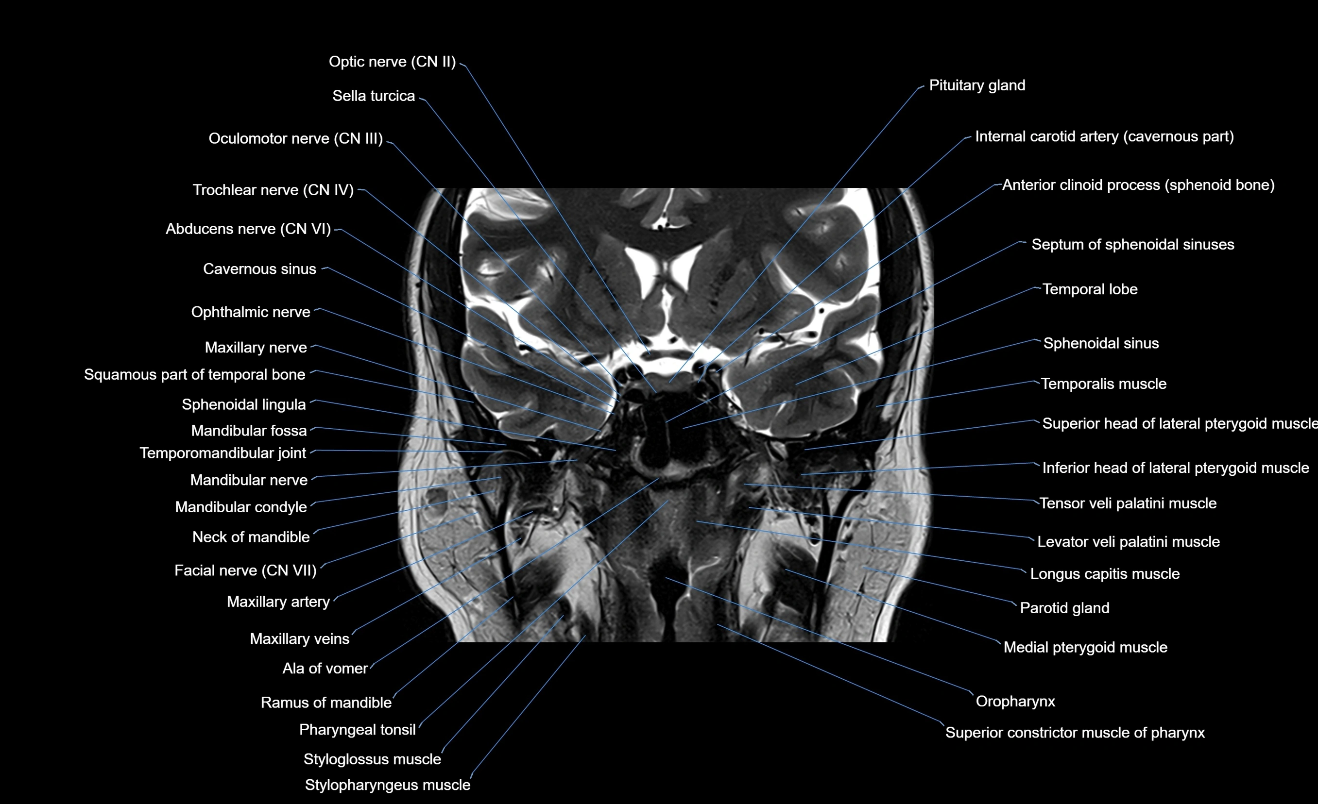 MRI face & paranasal sinuses(PNS) labelled  coronal  cross sectional anatomy 3T radiology  image-img-00001-00035.webp